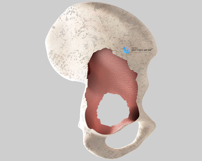 Destrucción ósea de la pelvis tras la extracción del implante acetabular