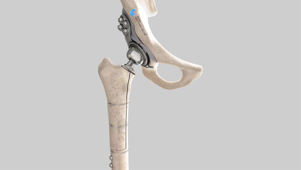 Changement complet de prothèse totale de hanche