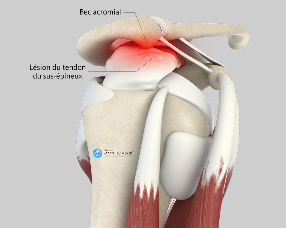 Acromioplastie de l'épaule par arthroscopie - Docteur Matthieu Meyer