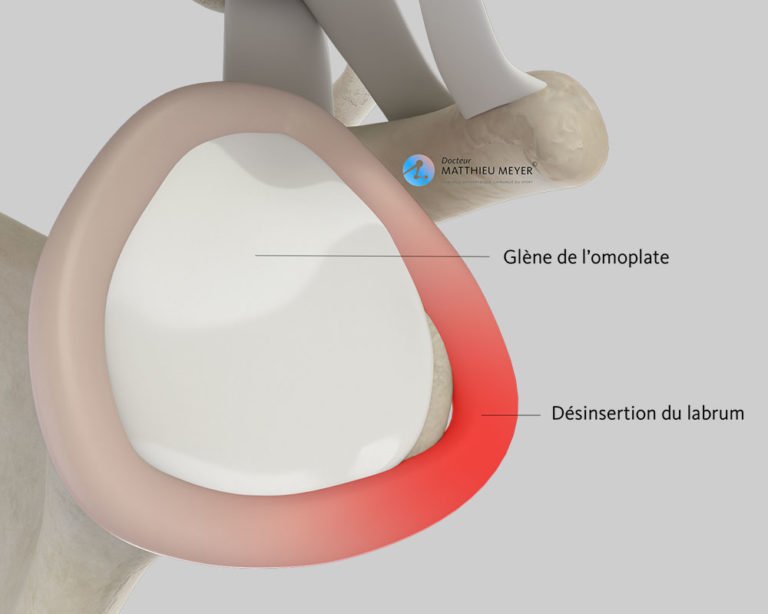 Réinsertion capsulolabrale par arthroscopie (Intervention de Bankart) Docteur Matthieu Meyer