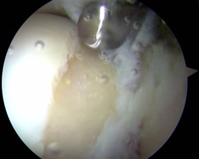 Vue arthroscopique après aplanissement de la came