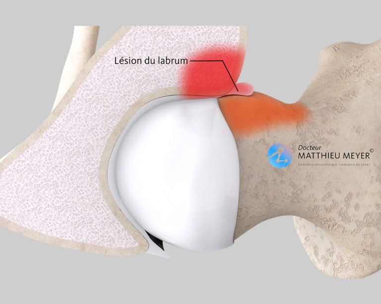 Arthroscopie pour conflit antérieur de hanche Docteur Matthieu Meyer