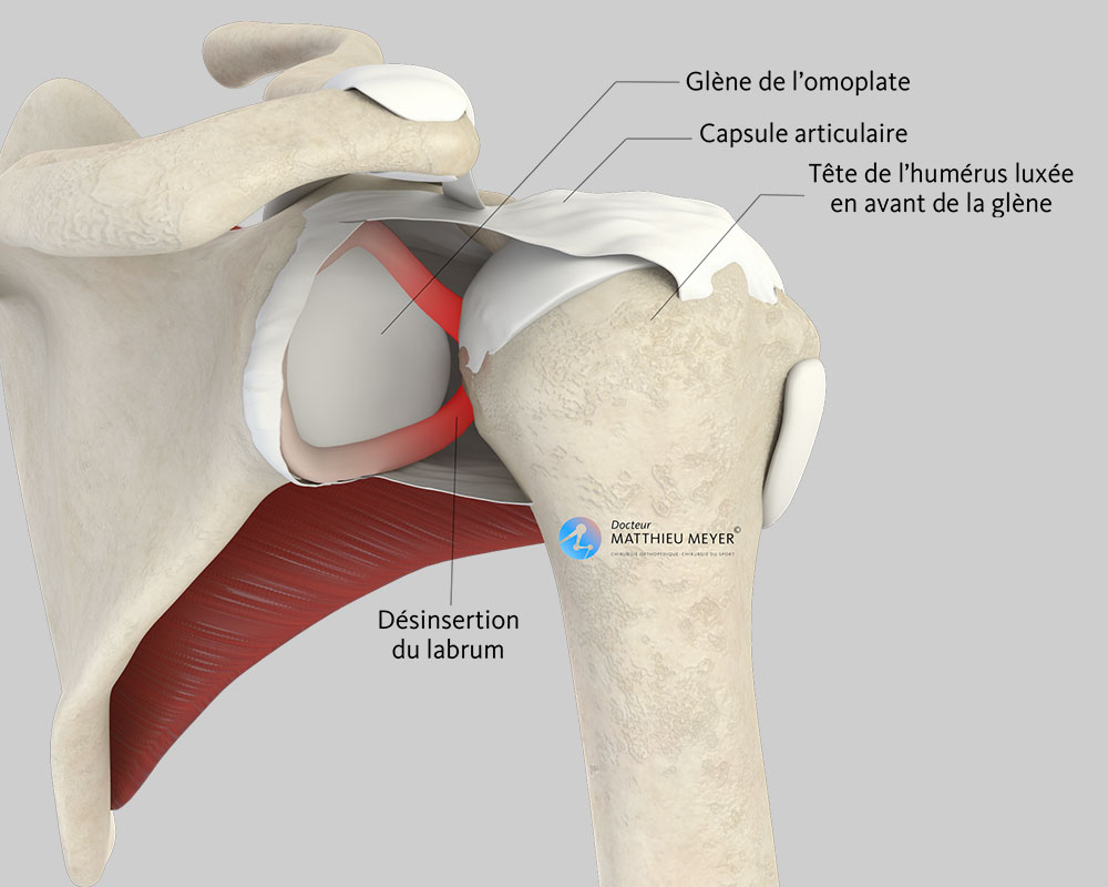 Butée coracoïdienne (Intervention de Latarjet) - Docteur Matthieu Meyer