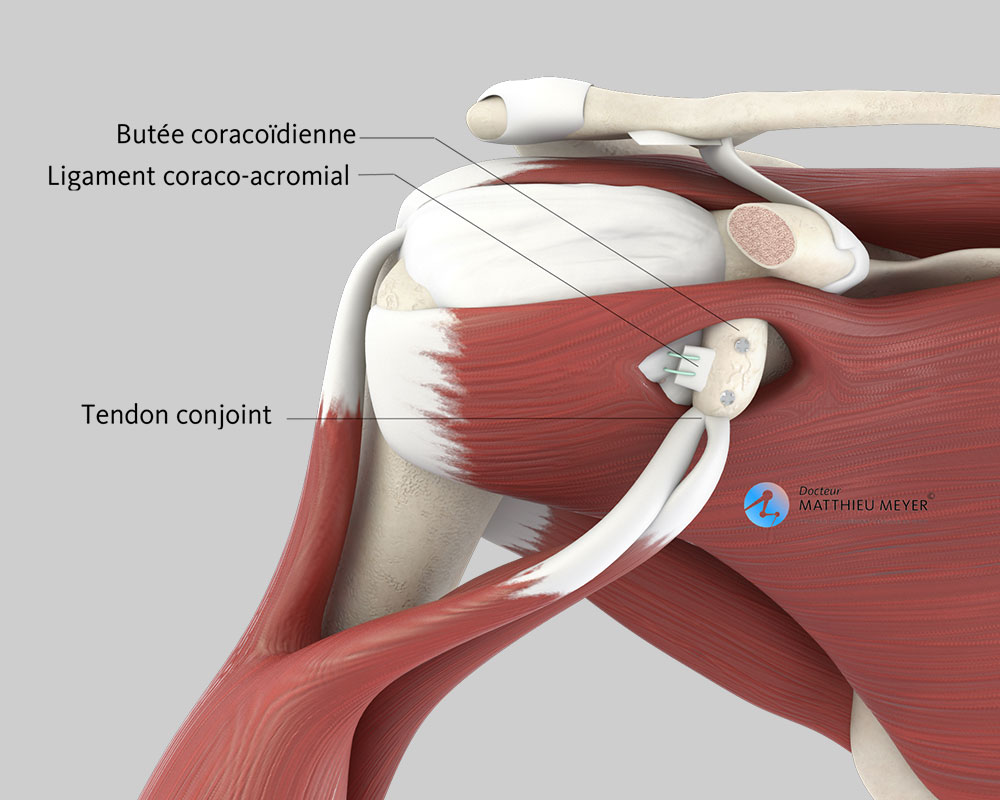 Butée coracoïdienne (Intervention de Latarjet) - Docteur Matthieu Meyer