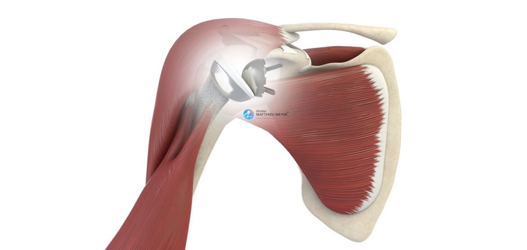 Prothèse totale d'épaule