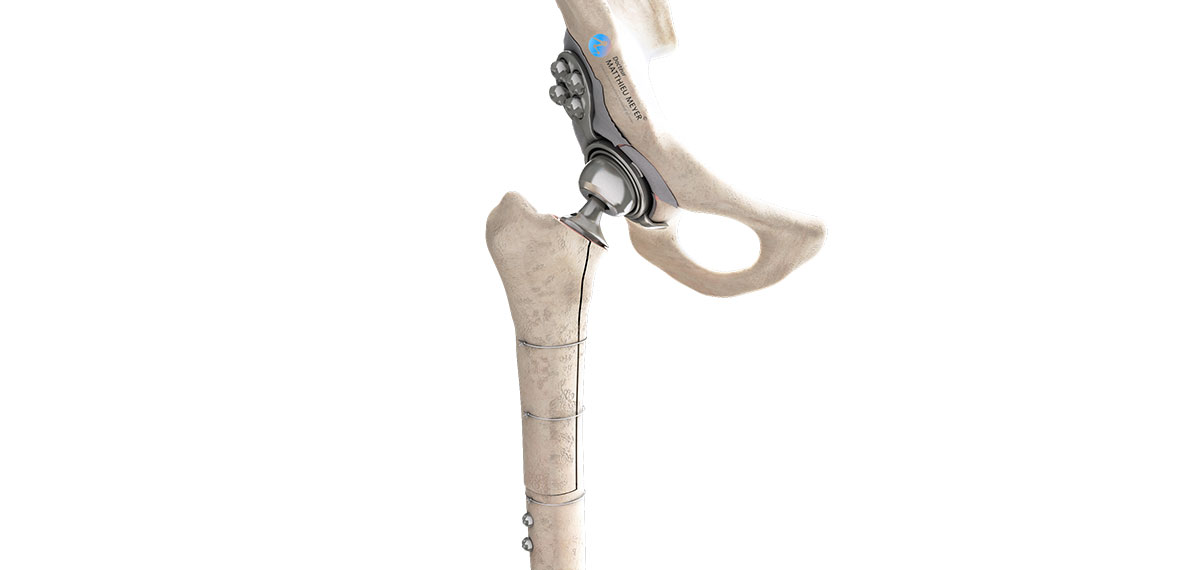 Changement de prothèse totale de hanche