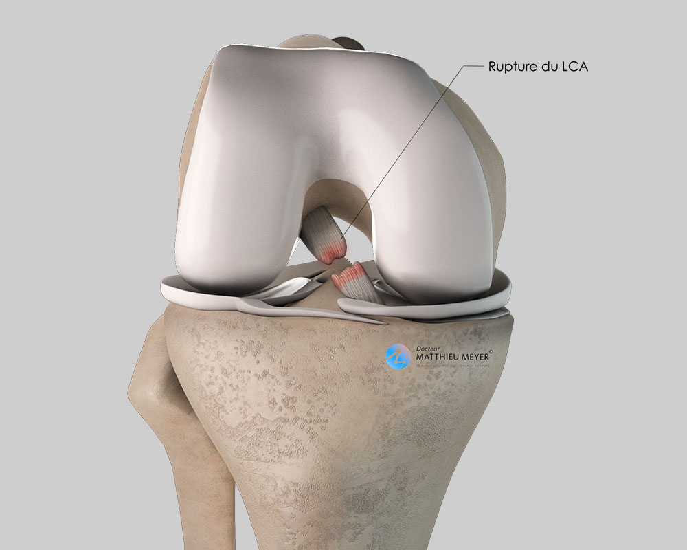 Ligamentoplastie du ligament croisé antérieur (Kenneth-Jones ...