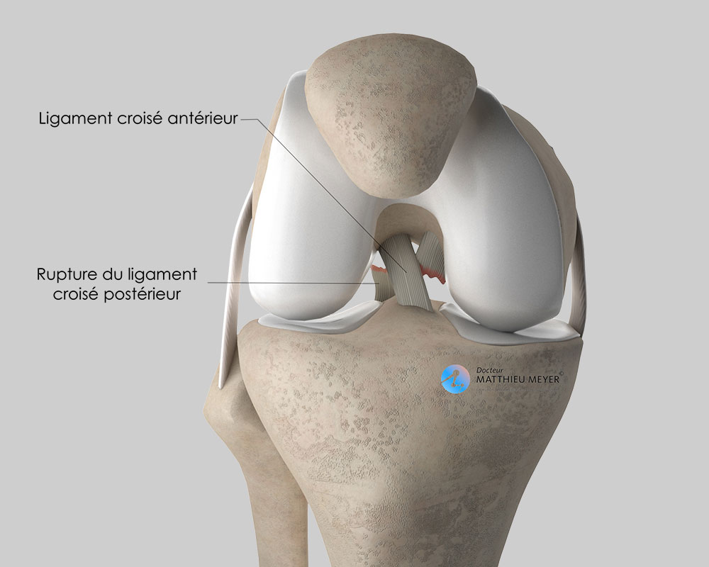 Ligamentoplastie du Ligament Croisé Postérieur - Docteur Matthieu ...