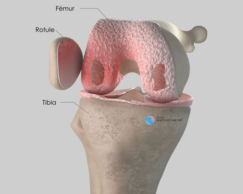 Usure diffuse du cartilage du genou