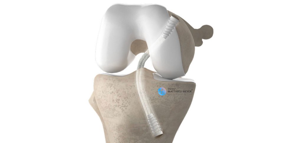 Ligamentoplastie du Ligament Croisé Postérieur