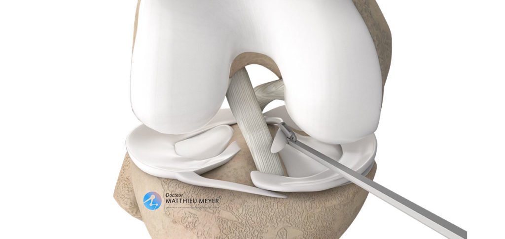 meniscectomía y sutura meniscal por artroscopia