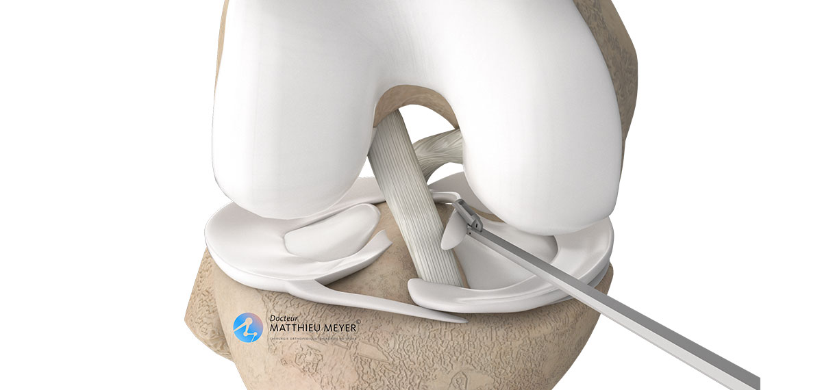 méniscectomie et suture méniscale par arthroscopie Docteur Matthieu Meyer