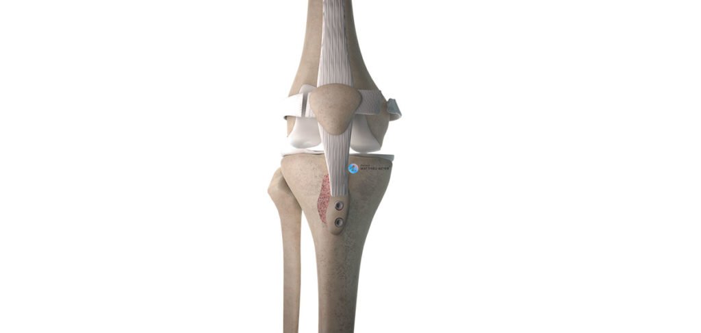 Recentrado rotuliano por osteotomía de la tuberosidad tibial anterior