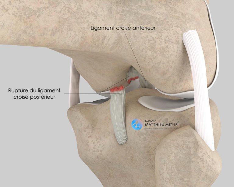 Ligamentoplastie du Ligament Croisé Postérieur Docteur Matthieu Meyer