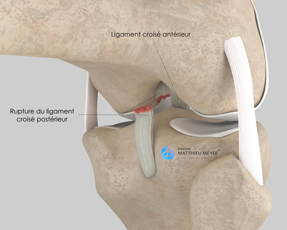 Rupture du ligament croisé postérieur (vue postérieure)