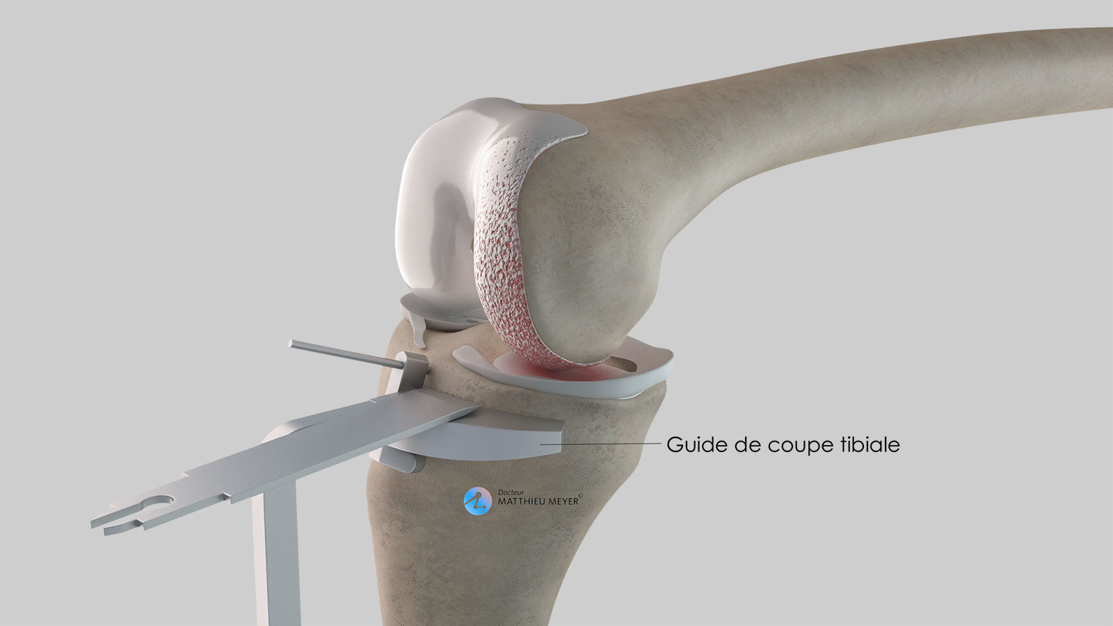 preparación tibial