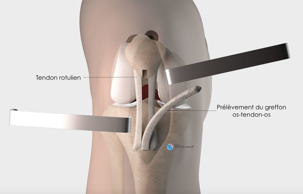 Prélèvement du greffon os-tendon-os