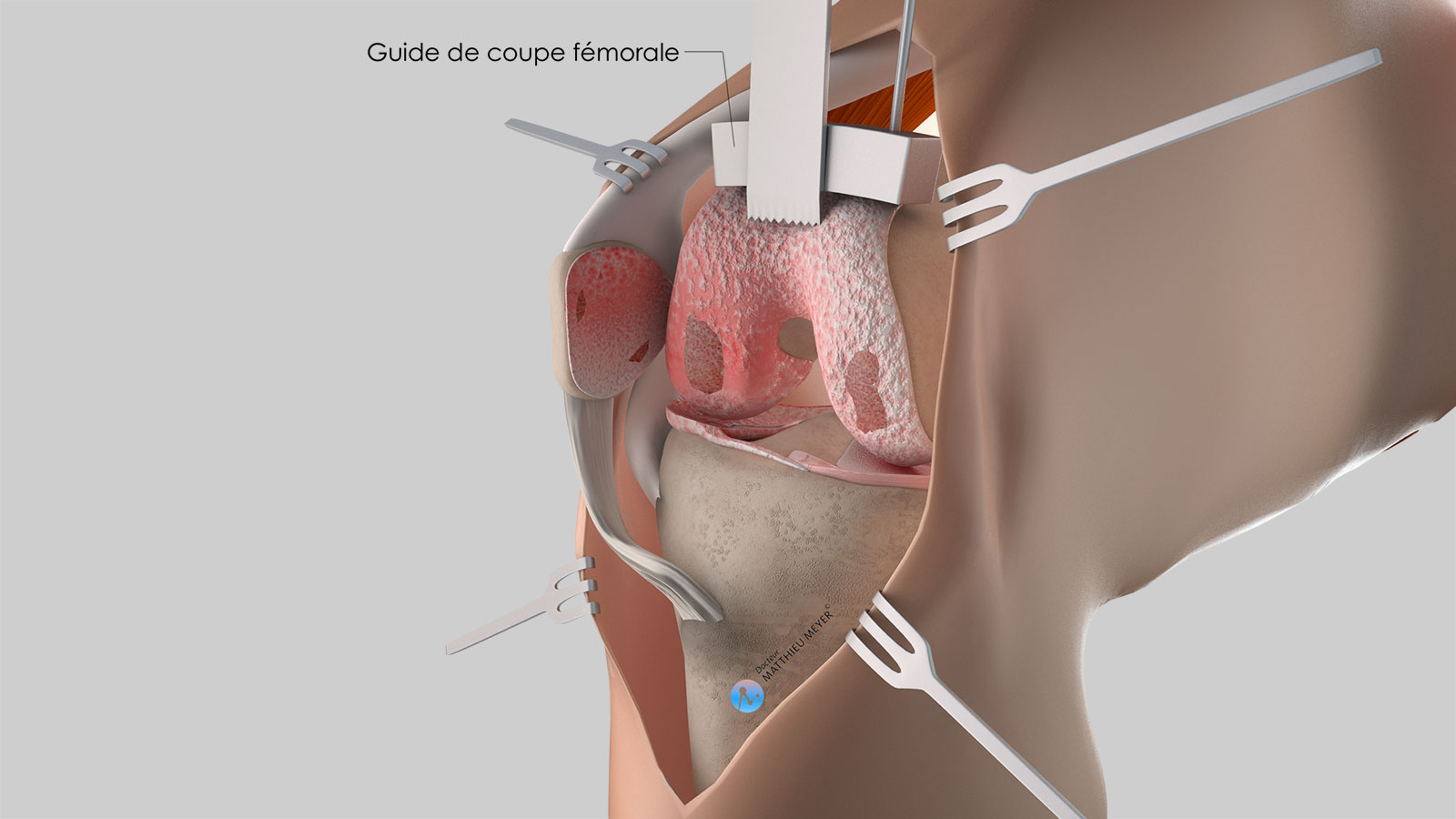 preparación femoral