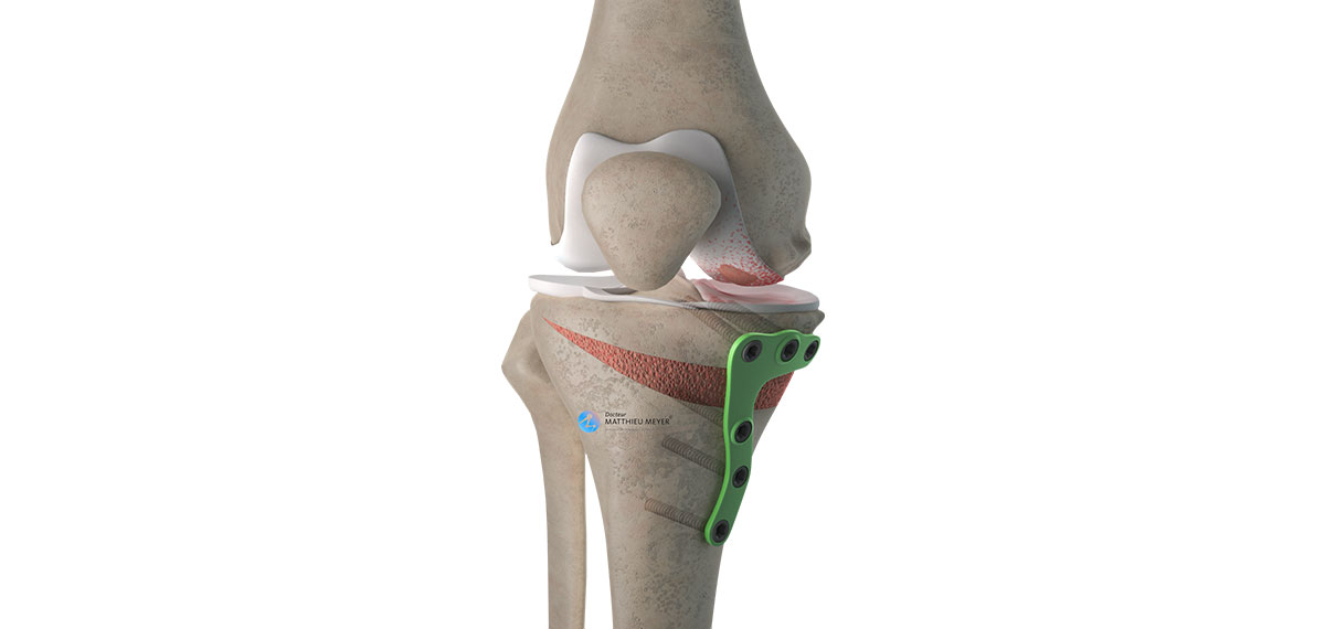 L'ostéotomie tibiale de valgisation de genou par ouverture interne ...