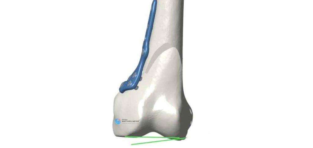 Osteotomía femoral en varo