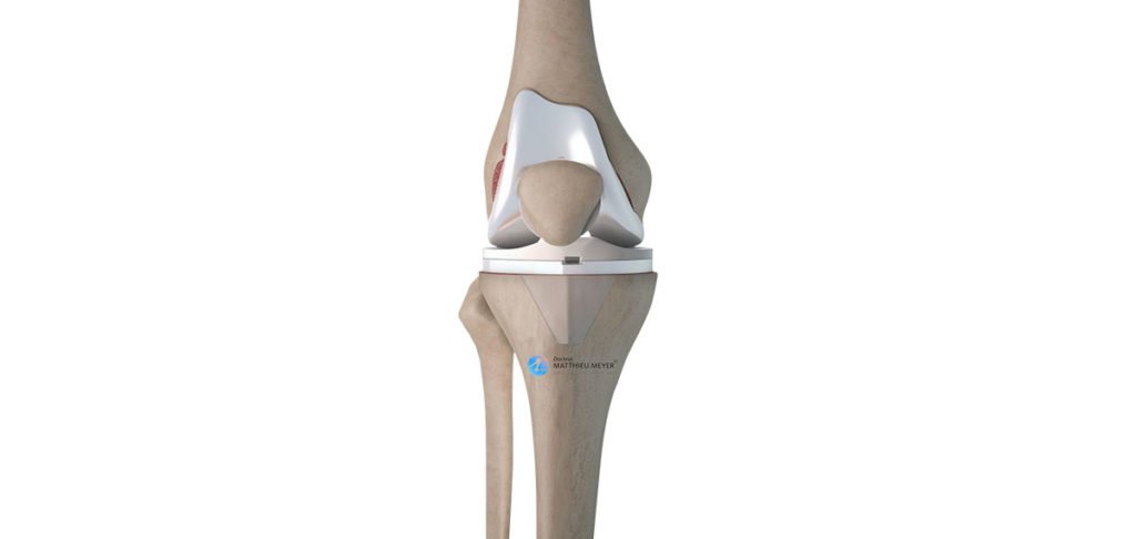 prótesis total de rodilla