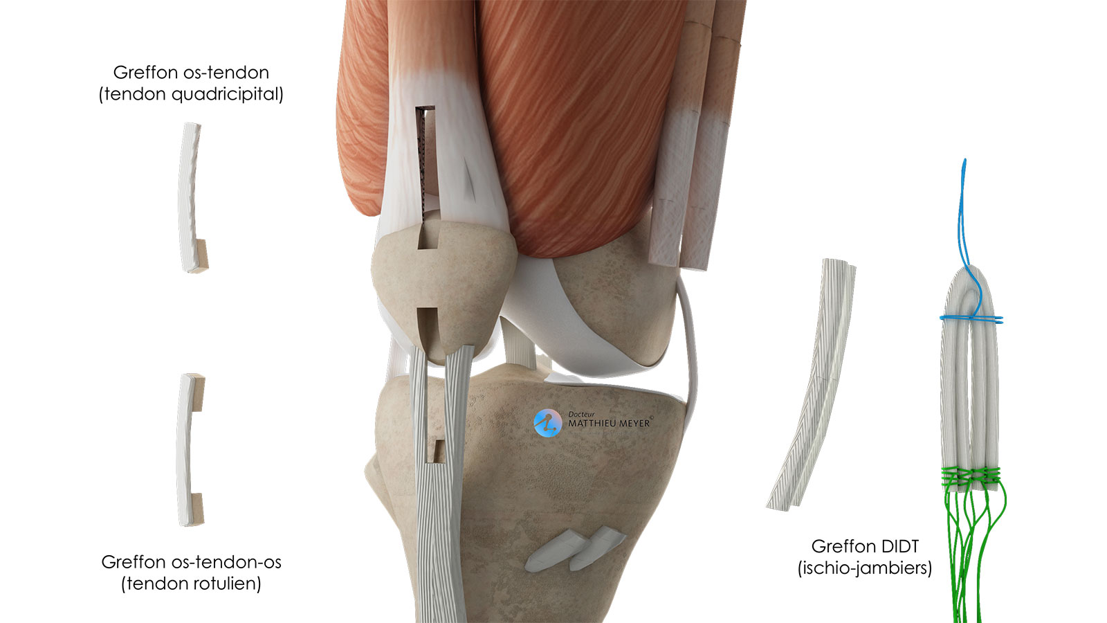 Ligamentoplastie du Ligament Croisé Postérieur - Docteur Matthieu ...