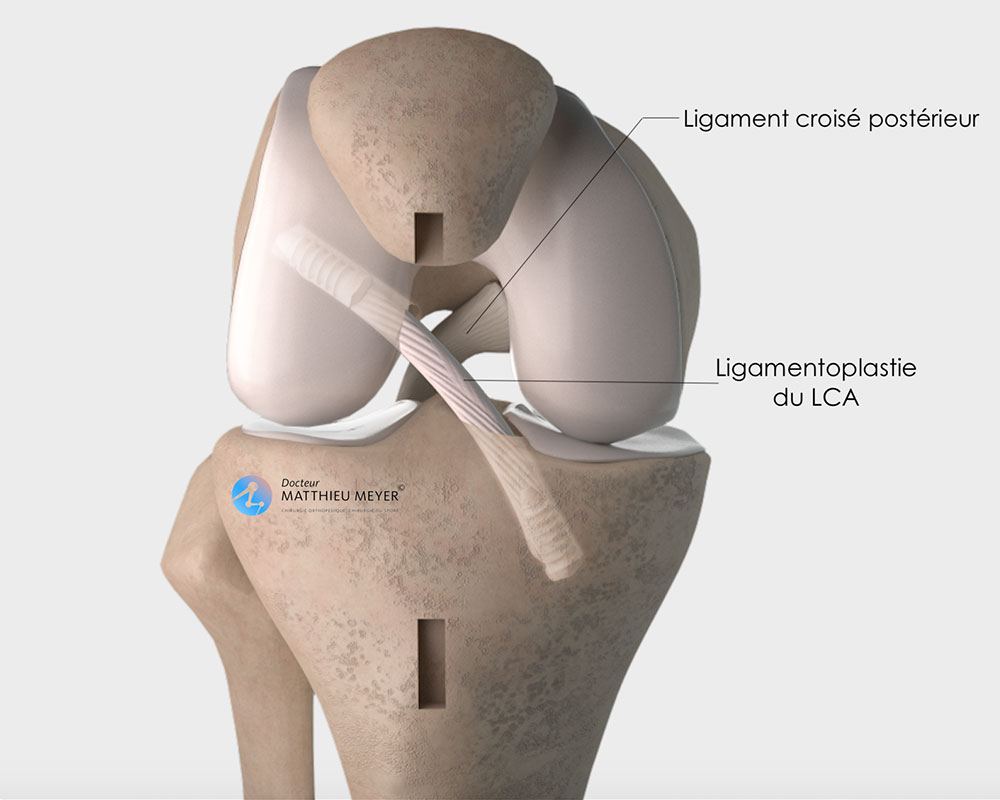 Ligamentoplastie du ligament croisé antérieur (Kenneth-Jones ...