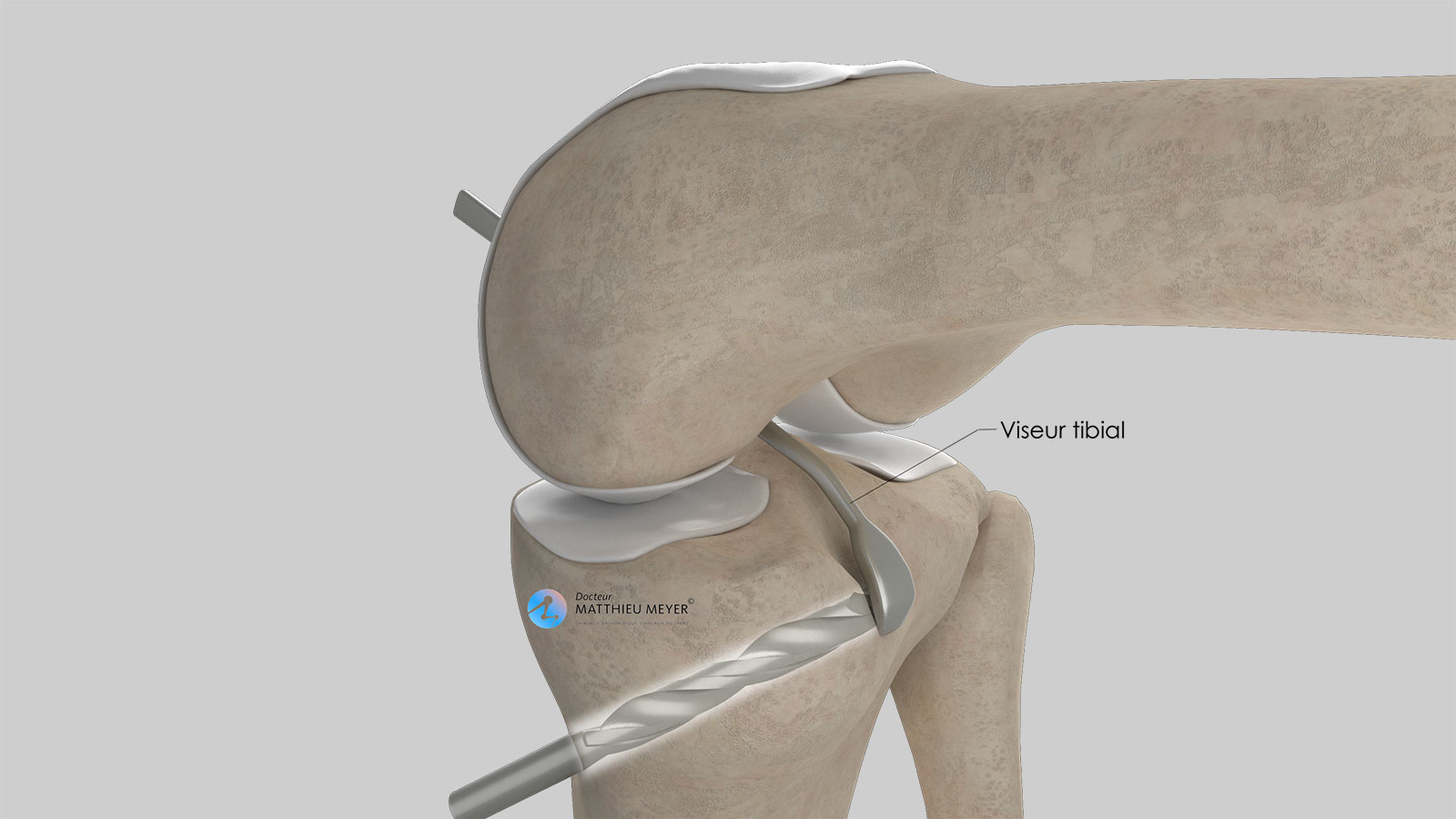 Realización del túnel tibial