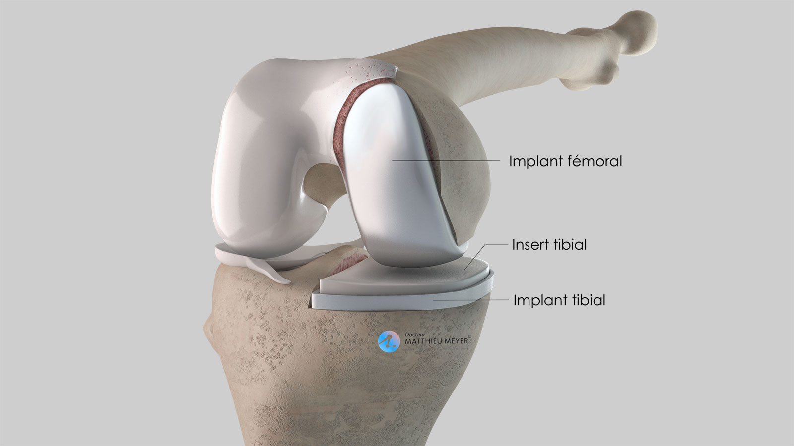 L'ostéotomie tibiale de valgisation de genou par ouverture interne -  Docteur Matthieu Meyer