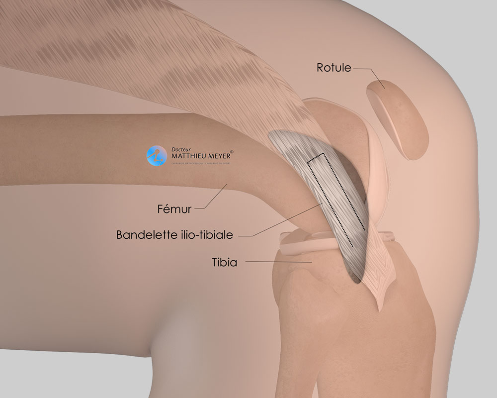 Reconstruction du ligament antéro-latéral : prélèvement de la bandelette ilio-tibiale