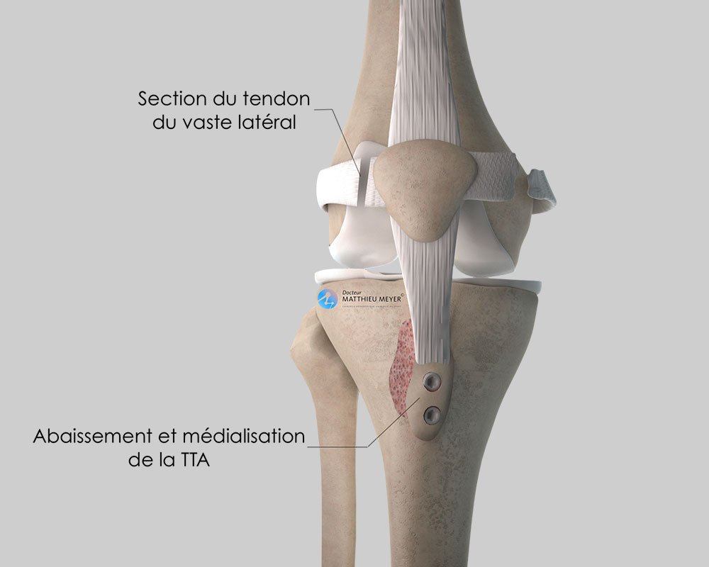 Recentrage rotulien par transposition de la tubérosité tibiale ...