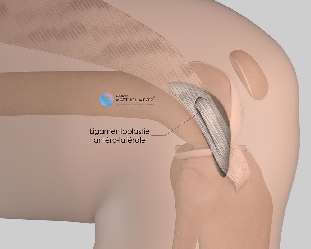 Reconstruction du ligament antéro-latéral : aspect final