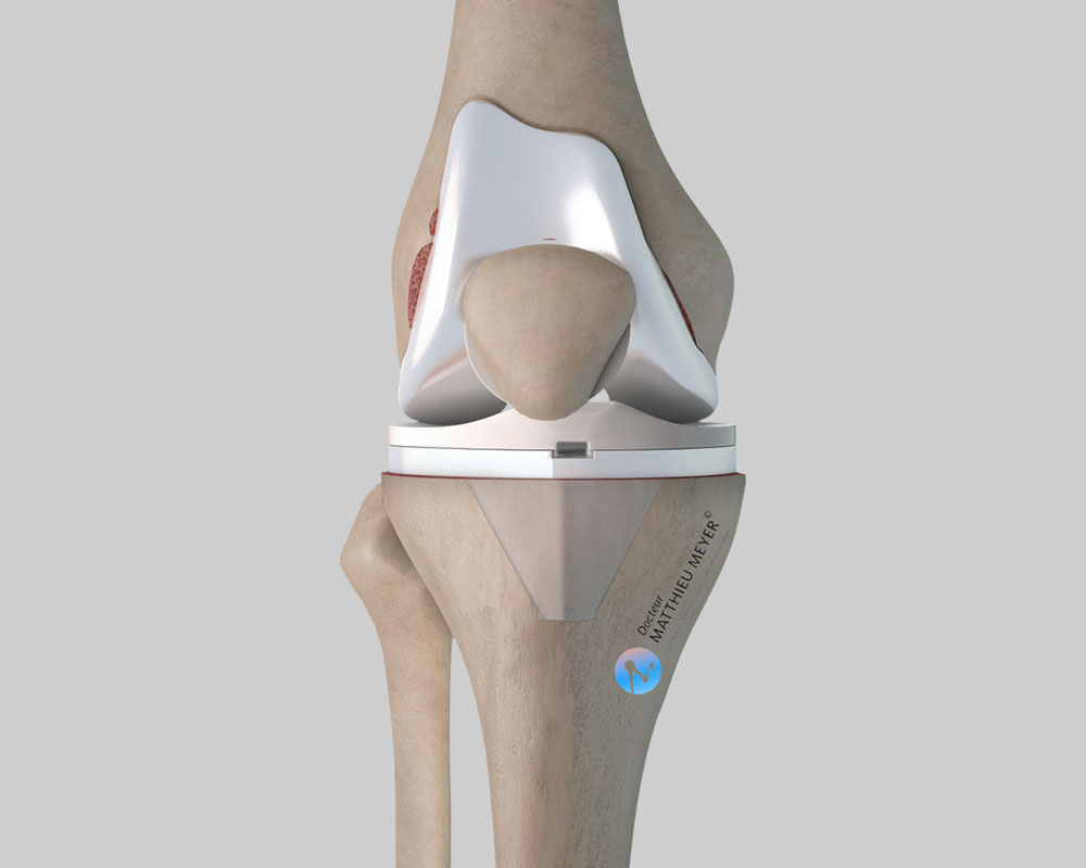 Prothèse totale de genou