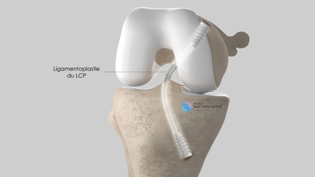 Ligamentoplastia LCP: aspecto final con mantenimiento del injerto mediante tornillos de interferencia