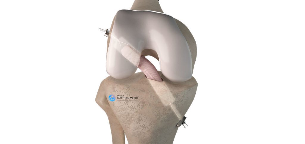 Ligamentoplastie du LCA par greffe courte au demi-tendineux (DT4)