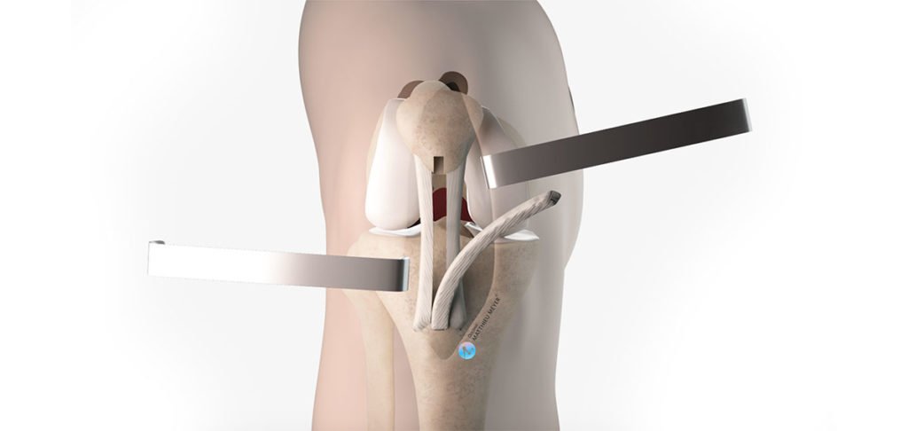 Reconstrucción del ligamento cruzado anterior - Kenneth-Jones