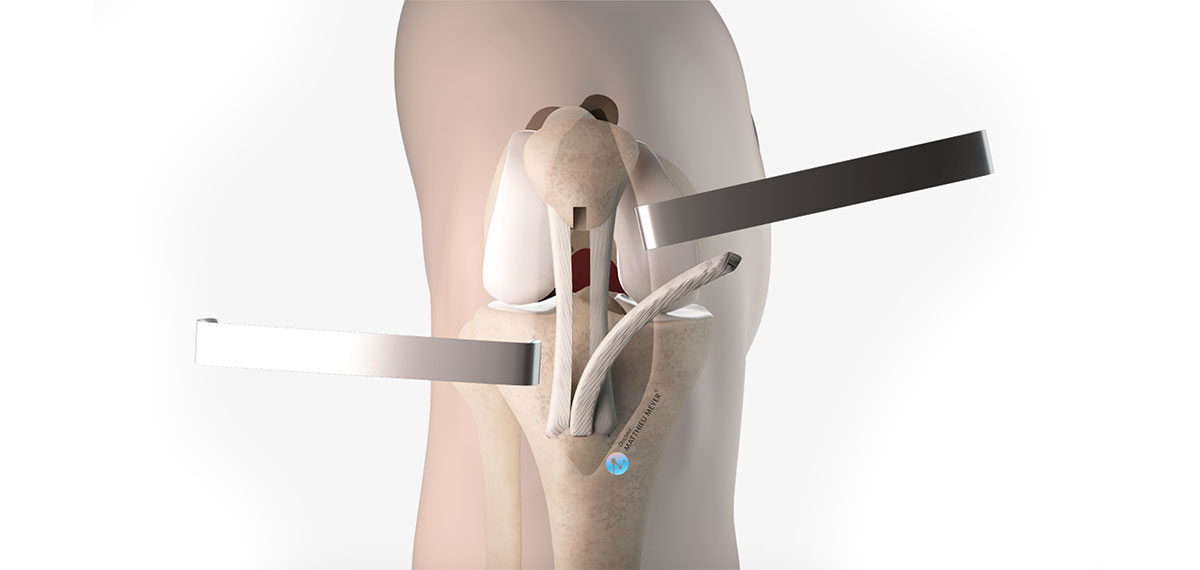 L'ostéotomie tibiale de valgisation de genou par ouverture interne -  Docteur Matthieu Meyer