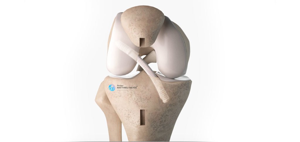 Reconstruction itérative du ligament croisé antérieur