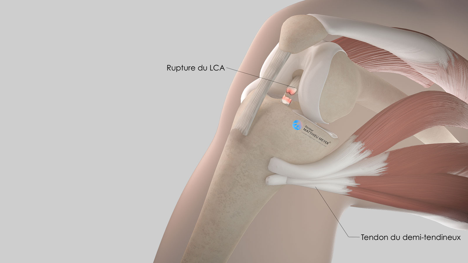 Ligamentoplastie du LCA par greffe courte au demi-tendineux (DT4 ...