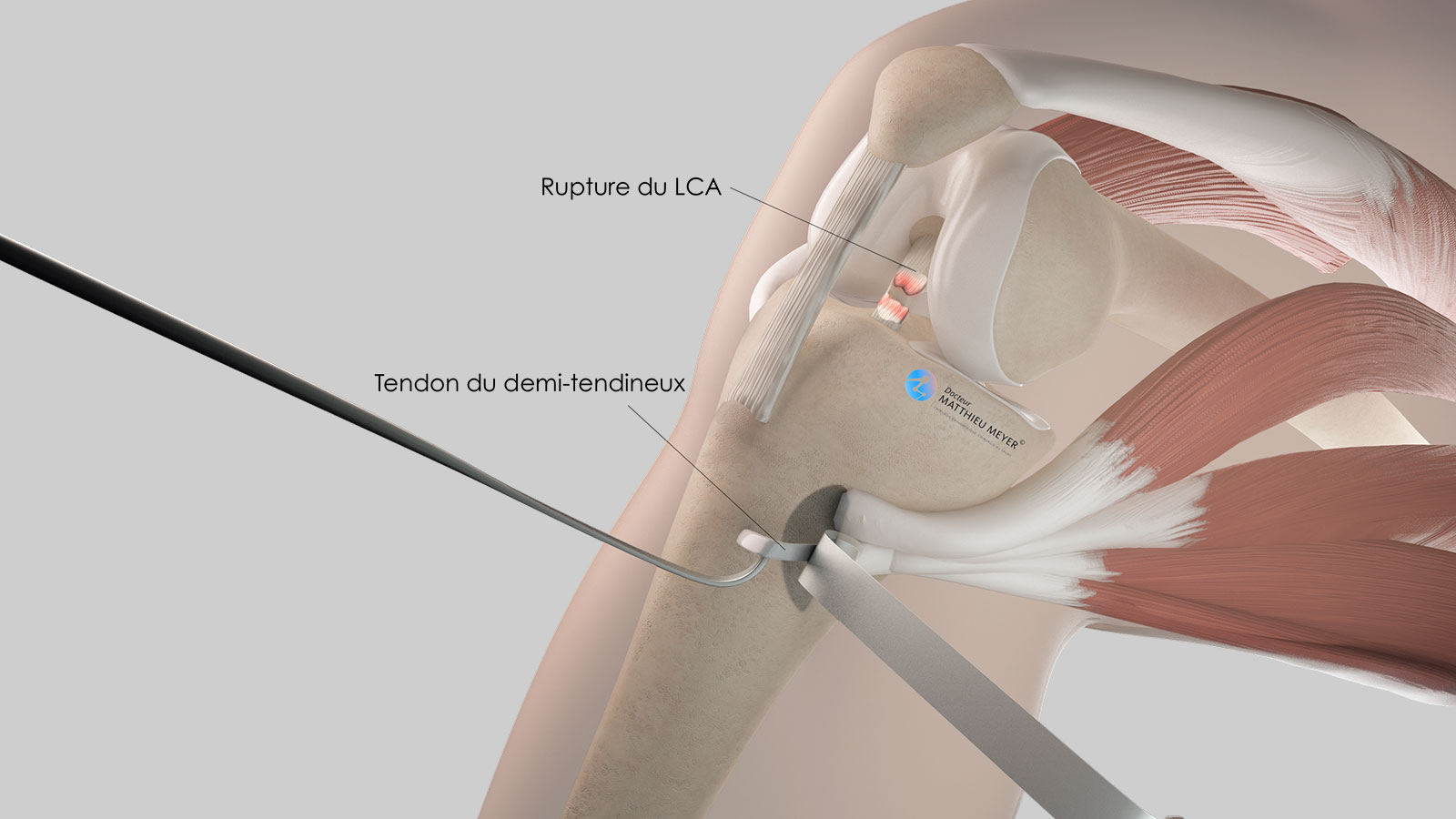 Ligamentoplastie du LCA par greffe courte au demi-tendineux (DT4 ...