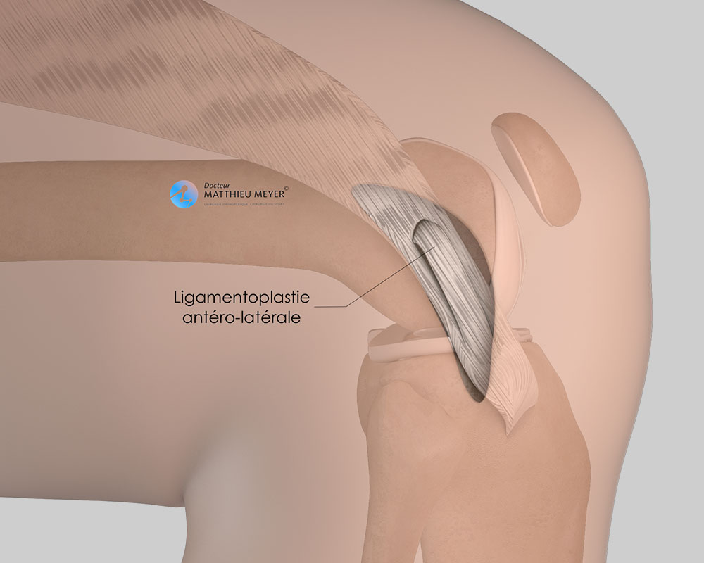 Reconstruction du ligament antéro-latéral : aspect final