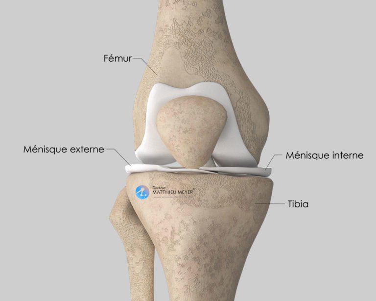 méniscectomie et suture méniscale par arthroscopie Docteur Matthieu Meyer