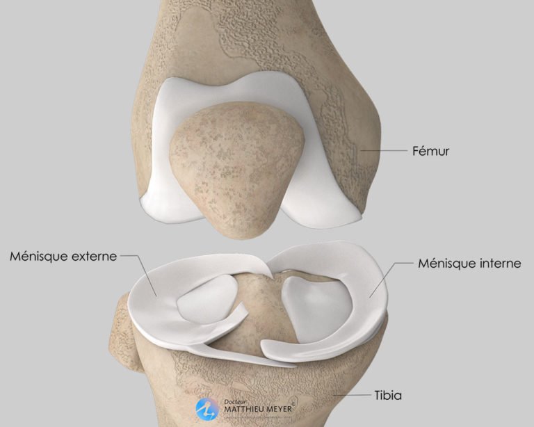 méniscectomie et suture méniscale par arthroscopie Docteur Matthieu Meyer