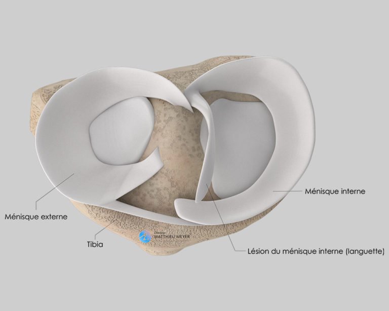 méniscectomie et suture méniscale par arthroscopie - Docteur Matthieu Meyer
