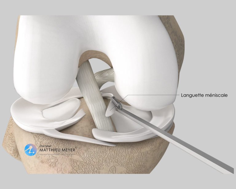 méniscectomie et suture méniscale par arthroscopie Docteur Matthieu Meyer