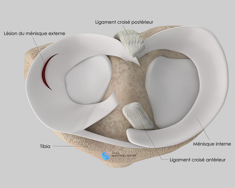 méniscectomie et suture méniscale par arthroscopie - Docteur ...