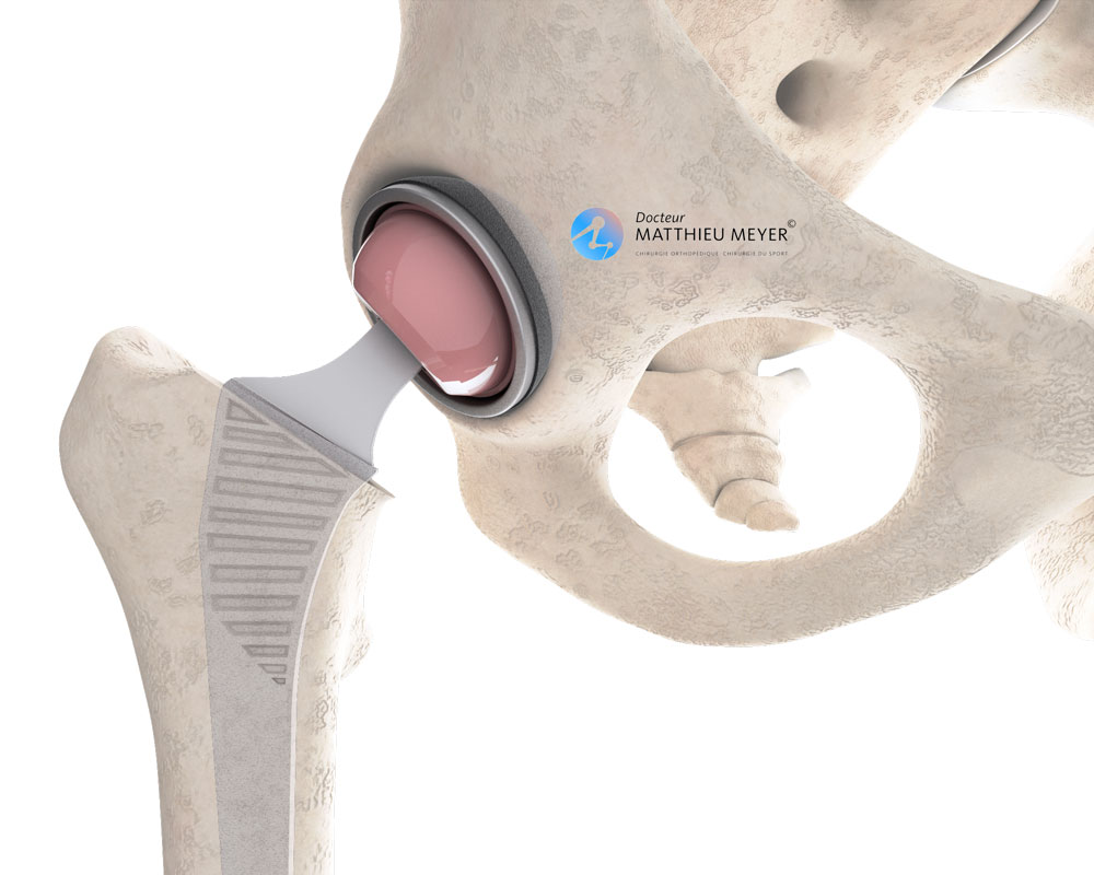prótesis total de cadera