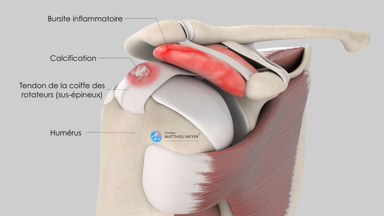 Evacuation de calcification de la coiffe des rotateurs par ...