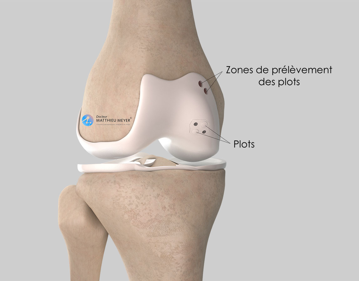 Perforations, refixations et greffes ostéochondrales - Docteur ...