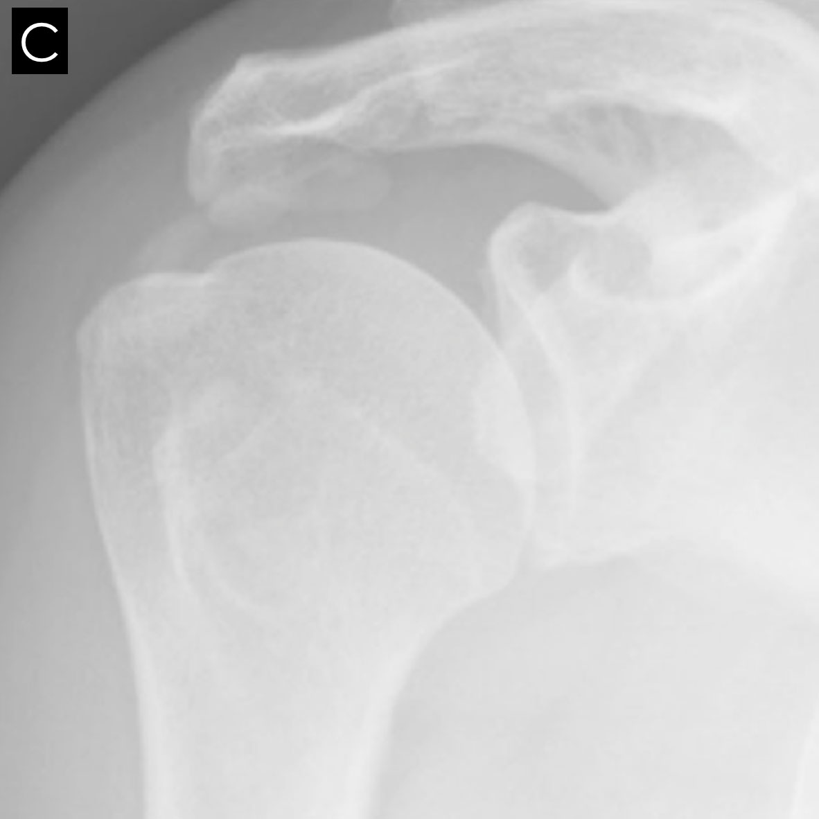 Evacuation de calcification de la coiffe des rotateurs par ...